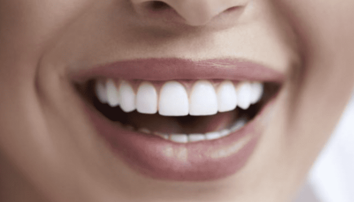 Teeth Whitening and Dental Implants
